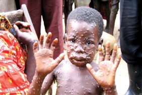 Health official: monkeypox virus still not a cause for alarm, no travel restrictions planned 