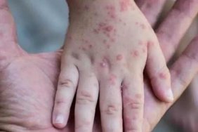 Georgia confirms first case of monkeypox virus 