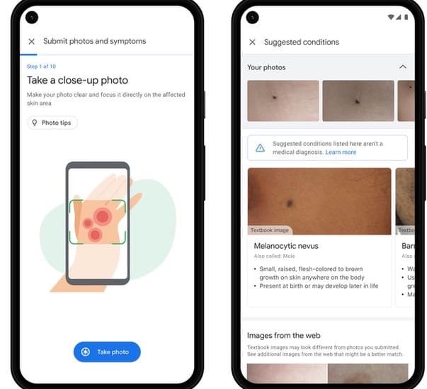 Google AI tool can help patients identify skin conditions