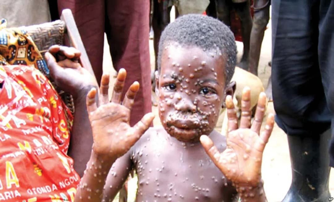 Health official: monkeypox virus still not a cause for alarm, no travel restrictions planned