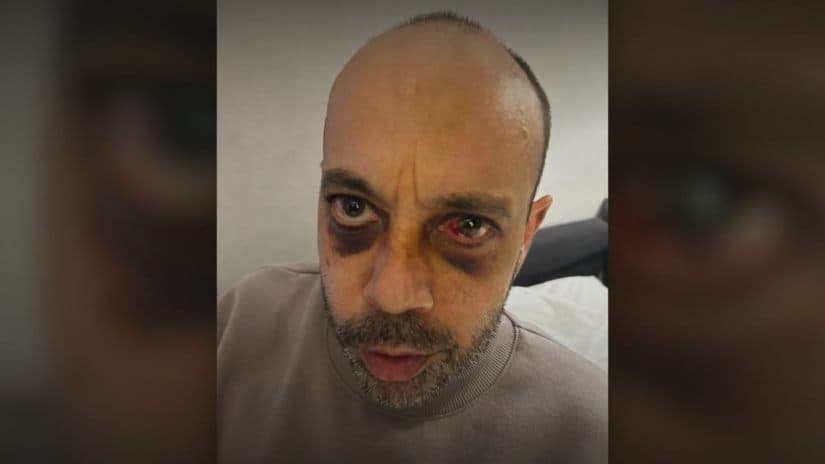 “ექიმმა გვითხრა, რომ შესაძლოა, ფატალური შედეგიც დადგეს, თუ ოპერაცია არ ჩაუტარდება” – აქციაზე ნაცემ აშშ-ის მოქალაქეს მძიმე დაზიანებები აღენიშნება