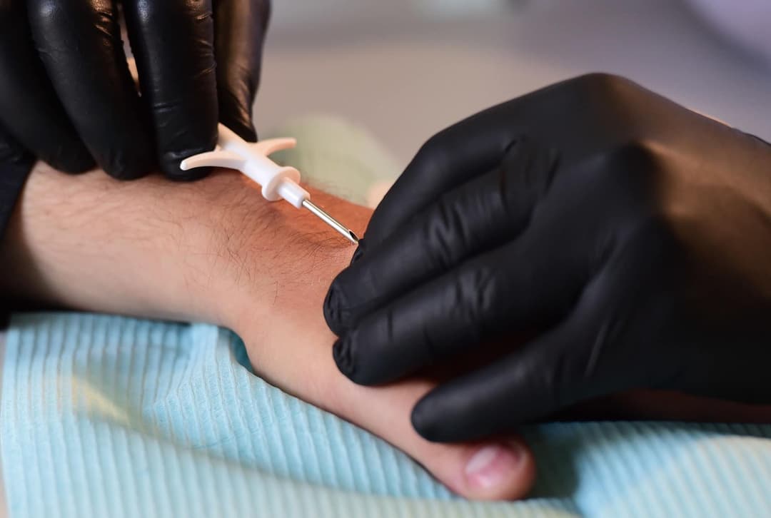 მომავალი წლიდან საქართველოში კანქვეშა ჩიპების შეძენა გახდება შესაძლებელი